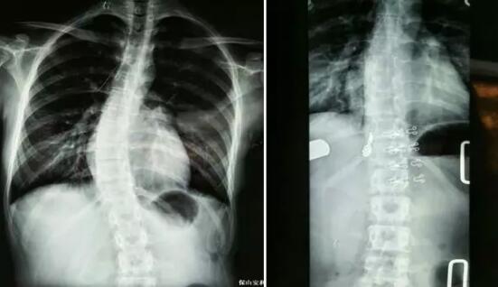 好好的脊柱怎么說彎就彎了？你竟然都沒發(fā)現(xiàn)……