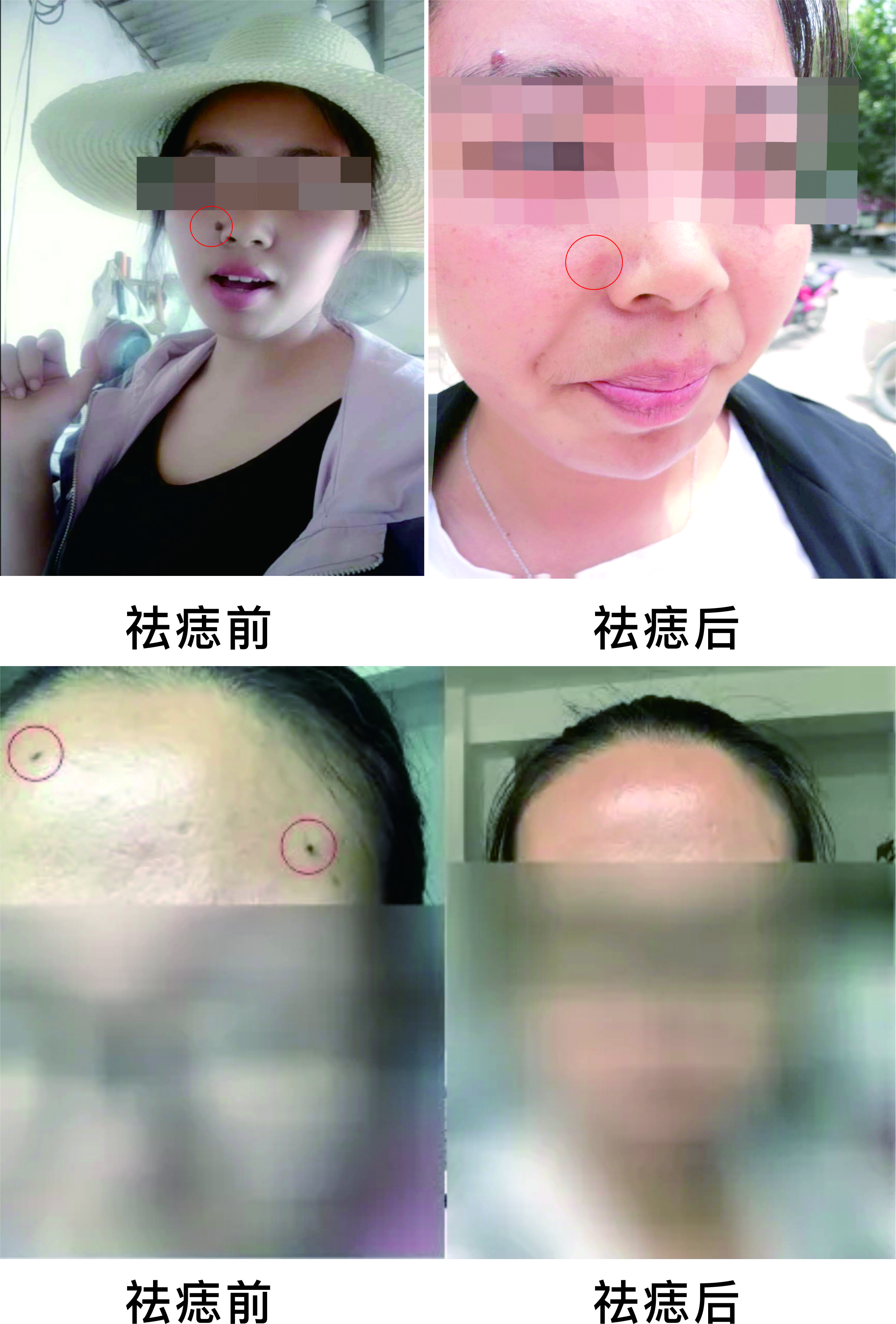 微波祛痣，告別臉部多余的“點(diǎn)綴”~